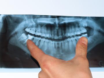 hand measuring jaw on dental x-ray | bruxism treatment arvada
