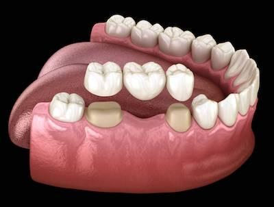 dental bridges in arvada