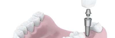 Diagram of dental implants arvada