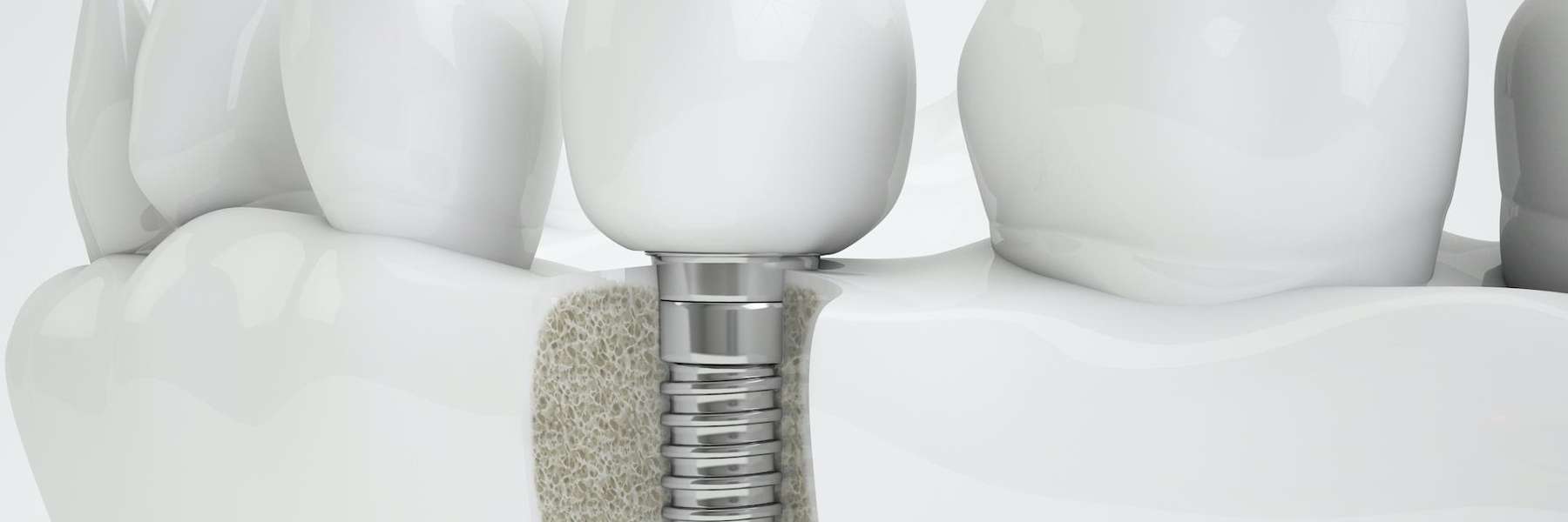 dental implants arvada | arvada dentist