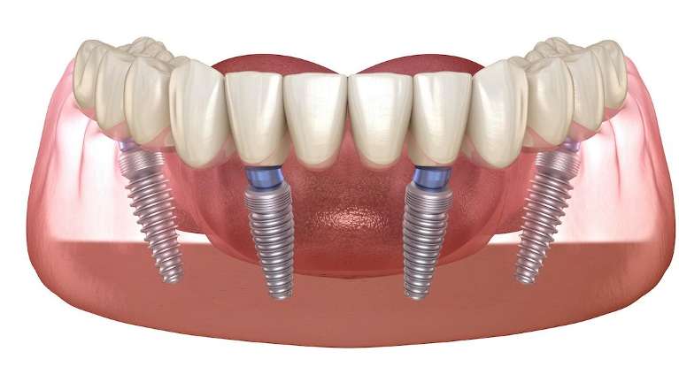 all on 4 dental implants arvada