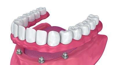 dental implants arvada